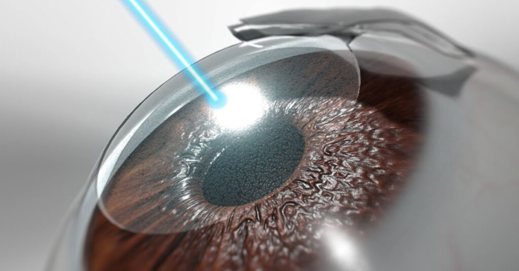 Sel Du Dr Toulemont ASSEMENT OF REFRACTIVE SURGERY INTEREST OF THE REFRACTIVE ERROR INDEX REI