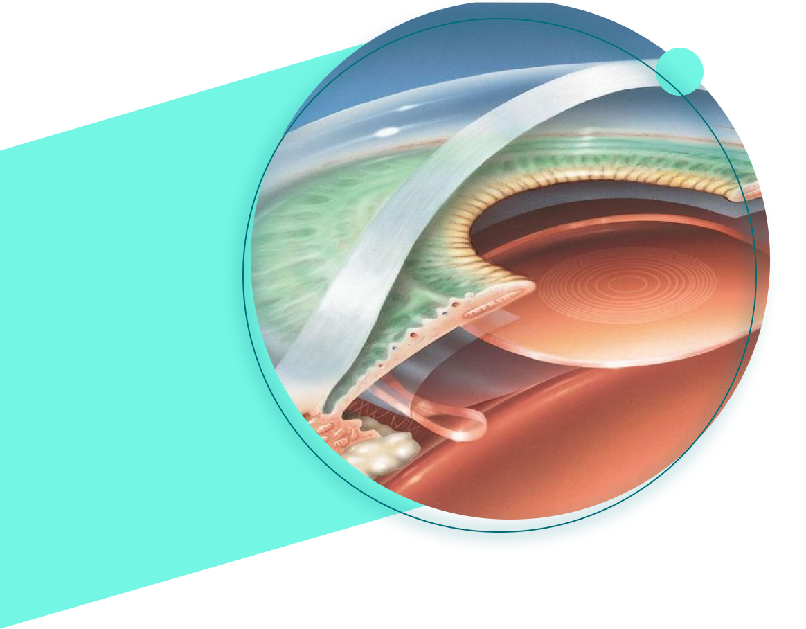 Sel Du Dr Toulemont CHIRURGIE ADDITIVE INTRA OCULAIRE