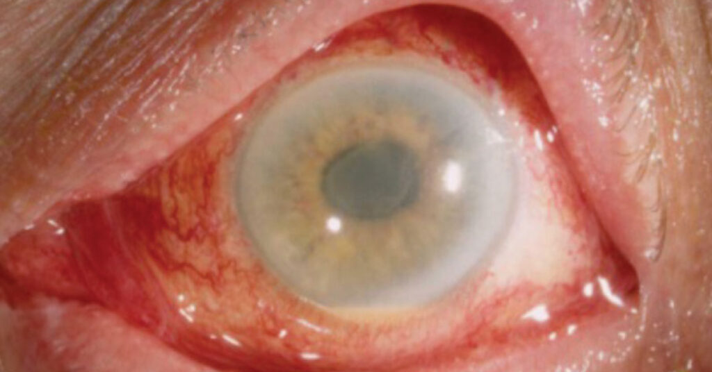 Sel Du Dr Toulemont COMPARAISON OF CORNEAL DAMAGE AFTER PHACOEMULSIFICATION VERSUS MANUAL PHACOFRACTURE