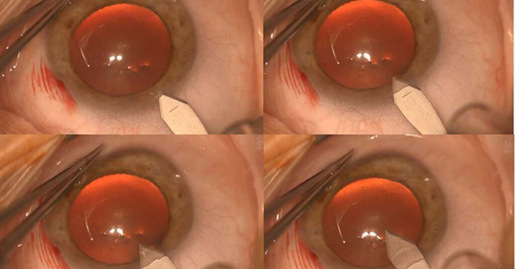 Sel Du Dr Toulemont COMPARAISON OF DESCEMETS MEMBRANE DAMAGE FOLLOWING PHACOEMULSIFICATION USING CORNEAL VALVE INCISIONS WITH CORNEAL OR SCLEROCORNEAL TUNNELS