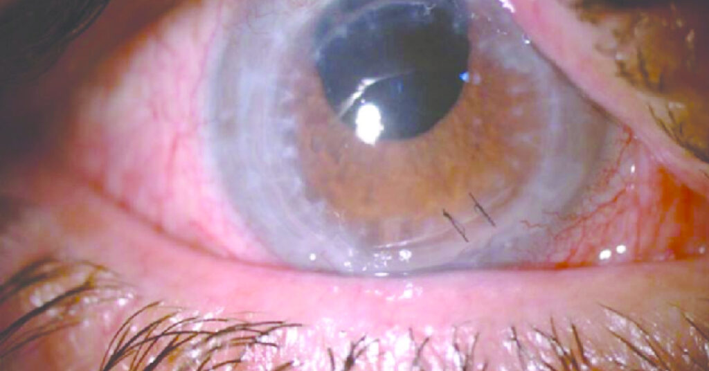 Sel Du Dr Toulemont COMPARAISON OF THE EFFECT OF INTRAOPERATIVE POSTOPERATIVE SUTURE ADJUSTEMENT ON ASTIGMATISM FOLLOWING PENETRATING KERATOPLASTY FOR KERATOCONUS