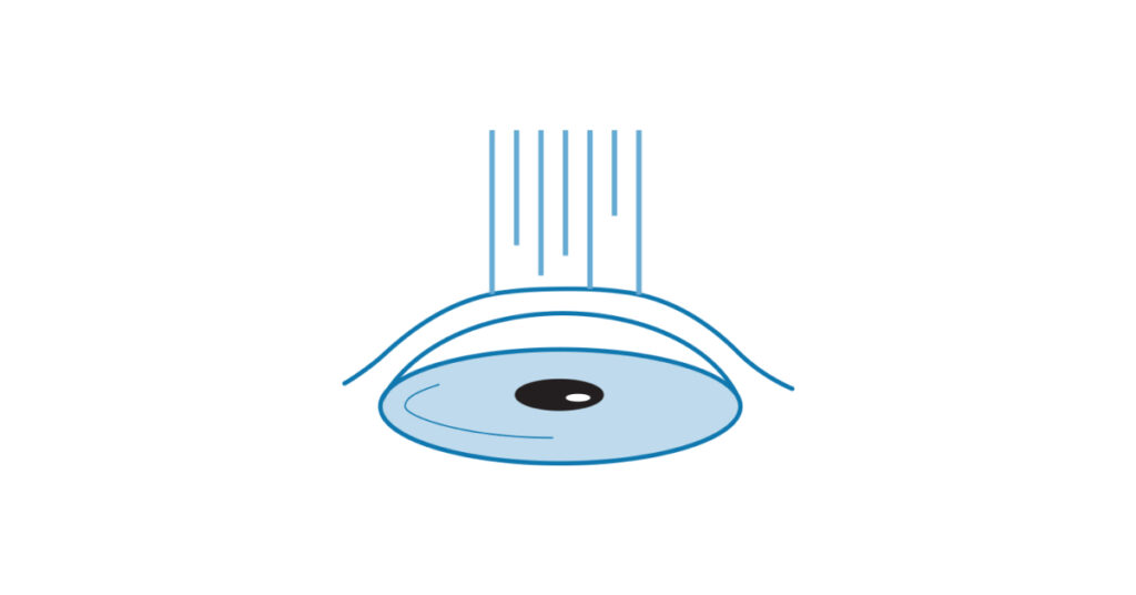 Sel Du Dr Toulemont EXCIMER LASER PHOTOREFRACTIVE KERATECTOMY TO CORRECT ASTIGMATISM