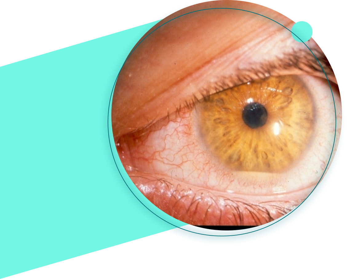 Sel Du Dr Toulemont H1 Oeil Normal Anomalies