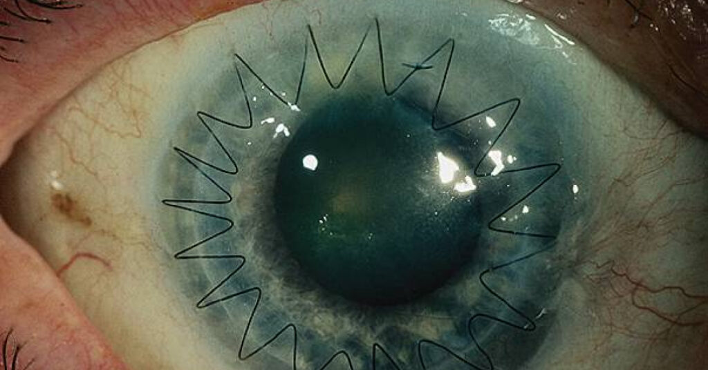 Sel Du Dr Toulemont INDICATIONS ET RESULTATS DES KERATOPLASTIES PERFORANTES A PROPOS DE 110 CAS
