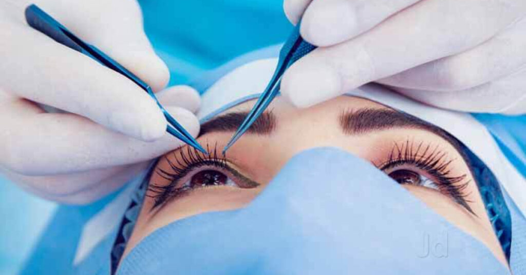 Sel Du Dr Toulemont MULTIVARIATE ANALYSIS VERSUS VECTOR ANALYSIS TO ASSESS SURGICALLY INDUCED ASTIGMATISM