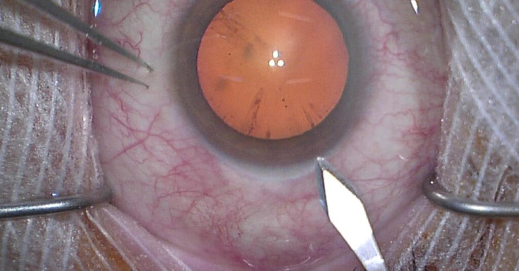 Sel Du Dr Toulemont QUELLE INCISION POUR LA PHAKO