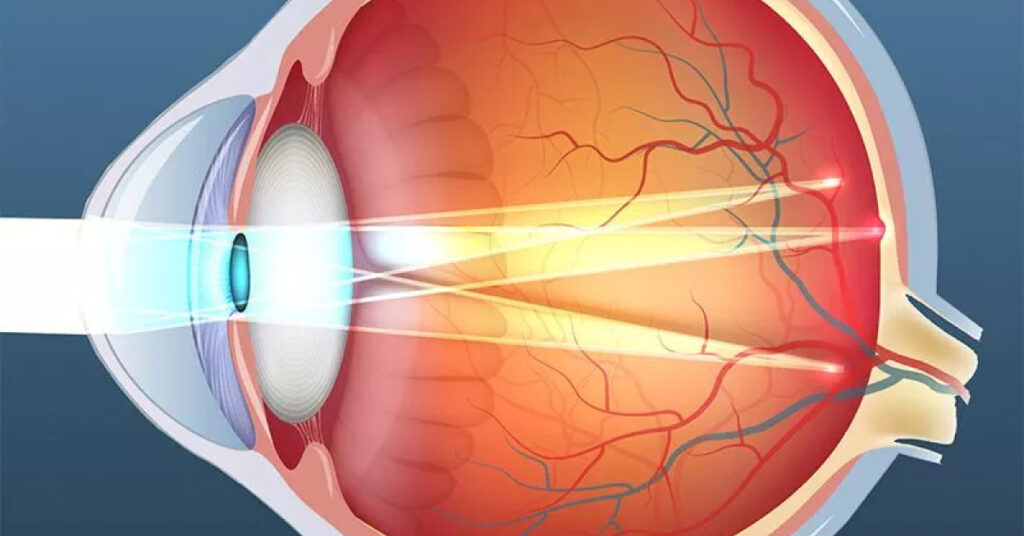 Sel Du Dr Toulemont SURGICALLY INDUCED ASTIGMATISM A NEW CONCEPT OF ANALYSE THE PROBABILITY METHOD.