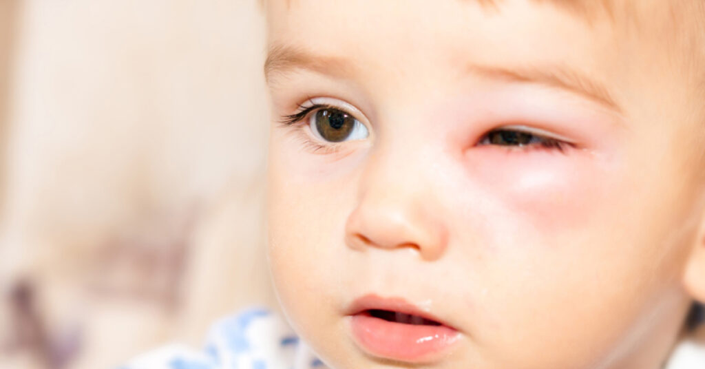 Sel Du Dr Toulemont TRAUMATOLOGIE OCULAIRE DE LENFANT